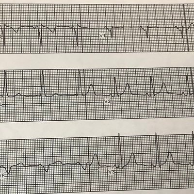 Arrhythmias. Cardiac Electrophysiology. ECG’s