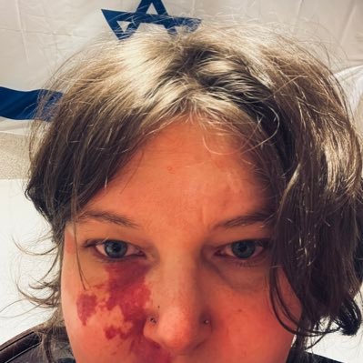 birthmark, adhd plus PTSD woman. know how to emotionally hurt self all day everyday.