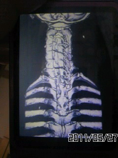 2007年12月腰椎椎間板ﾍﾙﾆｱOPE｡ 2010年2月OPLL後縱靭帯骨化症(頸椎､胸椎､腰椎)とOYL黄色靱帯骨化症(胸椎､腰椎)であると告知されました｡ OPLLは2011年2月15日にC2～T4の多椎間椎弓形成術と骨移植術のOPE｡ 現在は通院にてﾘﾊﾋﾞﾘ中｡