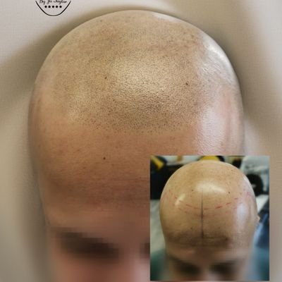 t4lrj's profile picture. Smp is one of the best hair loss solution around. It gives the appearance of a shaved head or much thicker hair.