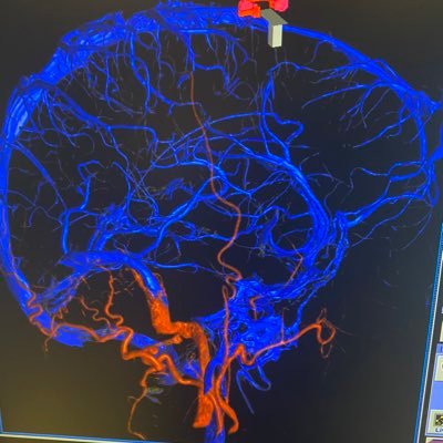 Montefiore Neurointerventional Surgery Profile