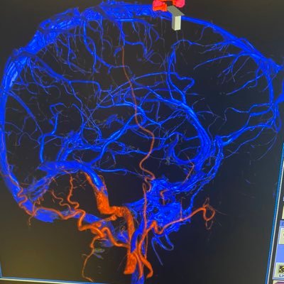 Official Account of NeuroInterventional Surgery at Montefiore Medical Center, Albert Einstein College of Medicine