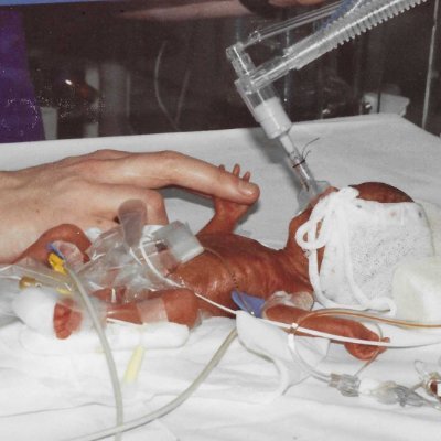 Adult born prem (26 weeks gestation, 430g)
Co-founder Adult Preemie Advocacy Network 
Adult Preemie Network 
@Adultpreemies