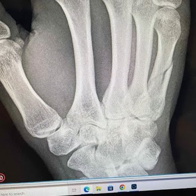 I broke my hand two weeks ago and now I can't work.
https://t.co/LePKkeFc4x