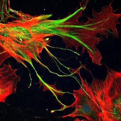 Research on KIDINS220 and PRKD1 Neuropathologies, SINO Syndrome, Hydrocephalus, Stroke and more in Teresa Iglesias´Lab @IIBmCSICUAM and @CIBERNED