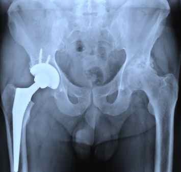 Hip_Help's profile picture. If you are concerned about your hip replacement please call our medical negligence specialists today for free legal advice on 0151 949 5150
