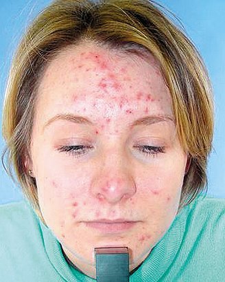 Yes i have terrible acne!