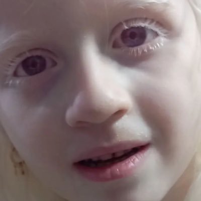 Only Albino/Albinism (OCA1a). Albinism will have no pigmentation at all so will have very white hair and pale skin.Their eyes will appear pale blue or grey.