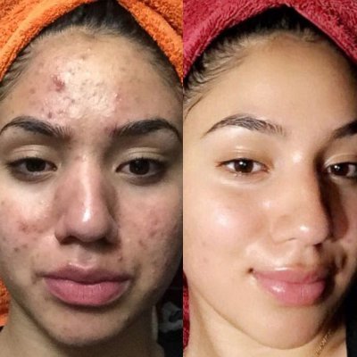 Remove_Spots's profile picture. Advanced Skincare for Ethnic Skin