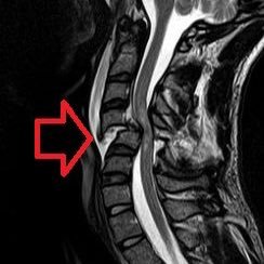 https://gofundme/7cb1f506….bring awareness and $ to Spinal Cord Injuries & research.