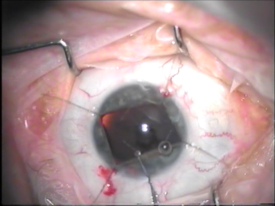 MofromDevon's profile picture. Optimax blinded me for over a year. I developed severe Post Traumatic Stress Disorder, look it up if you think thats nothing.