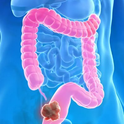 @RAHcolorectal