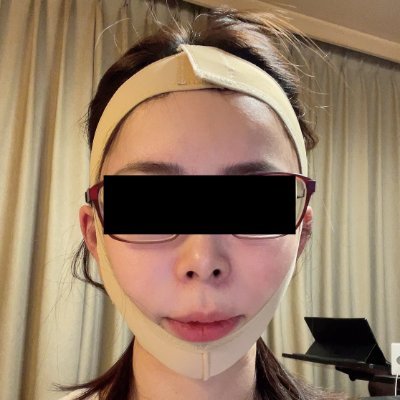45歳 フェイスリフト✂️│眉下切開│脂肪吸引│脂肪注入(おでこ・こめかみ)│糸リフト│アンチエイジング整形に特化👵