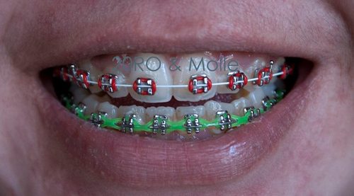 mahabeheljogja's profile picture. PEMASANGAN BEHEL ATAS BAWAH METAL 1,1 JUTA asisten dokter. LENGKAPBERGARANSI&TERJAMIN KUALITASNYA SMS 08995400653 PIN BB : 32D9AC69