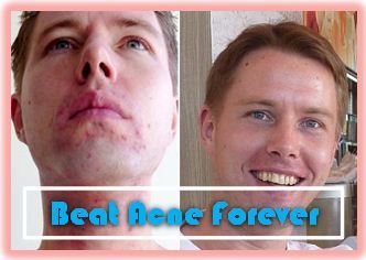 Thousands Have Beaten Acne,Discover How 1000's Are Getting Rid Of Acne In Just days.