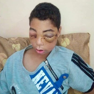 Abdul Karim is a child who is no more than 13 years old. He was shot during the war in Gaza and needs surgery and expensive medicine. I hope you can help him so
