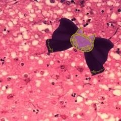 Spongiform encephalopathy. fear my prion