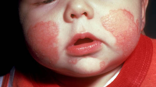 I am trying to raise awareness for eczema in infants.