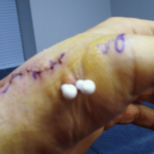 trials and tribulations with New Jersey workers compensation