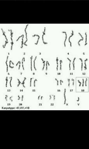 18Trisomy's profile picture. Account made my Taylor Melsop and Kendra Pauly to publicly inform you about the disorder of Trisomy 18. #TeamFollowBack :)