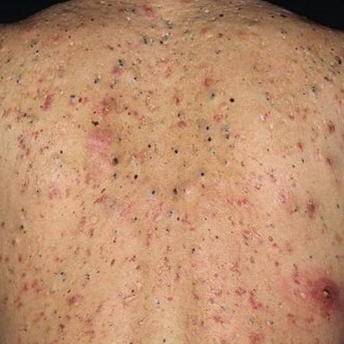 diagram acne for acne cure , best How for to DIY Akne diagram acne for acne cure , best How for to DIY Akne