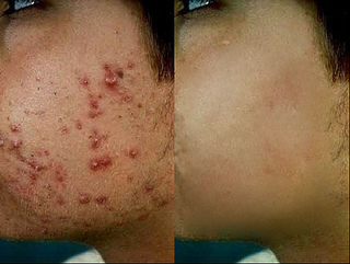 Get The Latest Tips On Ways To Have Healthy Acne Free Skin and Much More . . .