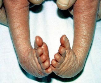 Research into the causes and consequences of congenital talipes equinovarus (CTEV) - clubfoot.  For families and scientists.
