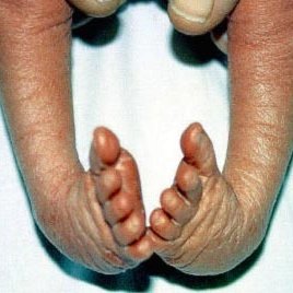 Clubfoot News Clubfoot News Twitter