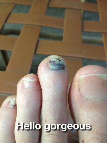 We are runners. We have ugly feet. We are not ashamed.
Send us pics of your ugly feet and we will post them: uglyfeetpics@gmail.com