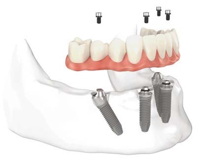 All-on-4™ is a simple dental procedure which gives patients a fixed prosthesis in 1 day by using only 4 implants, 2 straight and 2 angled