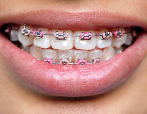Braces rock. 'Nuff said