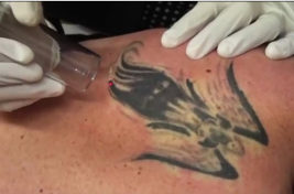 TattooRemovalz's profile picture. News, Tips and Ideas on Tattoo Removal, Type of Tattoos That Can Be Removed, The Cost, The Pain to Experience, Etc.