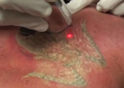 LaserTattooRem's profile picture. News and Ideas About Laser Tattoo Removal That Works With Less Cost and Pain, Etc.