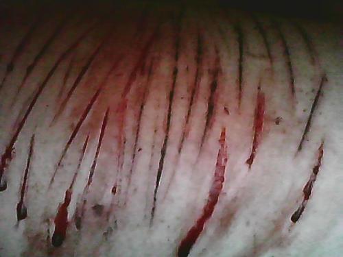 I cut, Abused, Hated, Suicide thoughts, 3 Suicide attempts, I starve... welcome to my life.