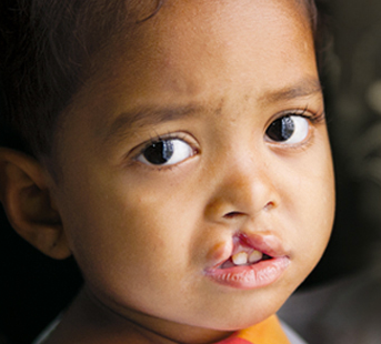 Desde 1999 venimos cambiando la vida de niños, jóvenes peruanos de escasos recursos  que padecen de labio leporino y paladar hendido.