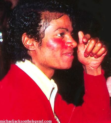 Our goal is to raise awareness of Vitiligo & Lupus