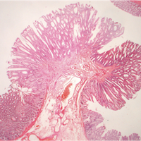 LynchSyndrome_Polyposis@StMarks (@stmarksgenomics) 's Twitter Profile