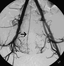 Neuroendocrine Tumors: Role of Interventional Radiology in Berlin