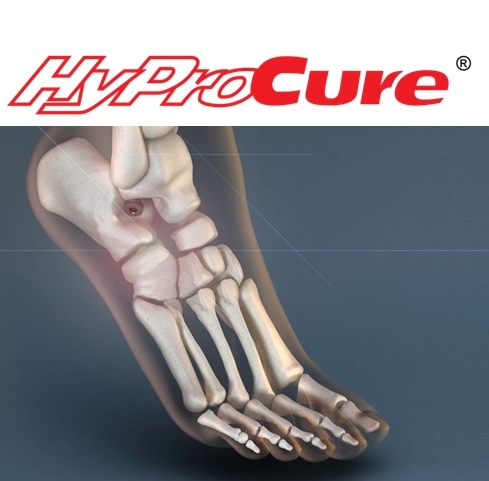 Don't suffer with #footpain #flatfeet #hyperpronation #backpain #kneepain and more. Learn about TaloTarsal Displacement and the HyProCure Solution.