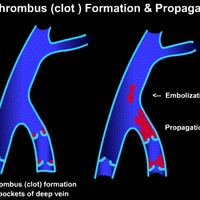 venous thrombosis (@legdvt) 's Twitter Profile