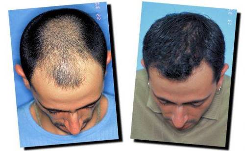 Hair Transplant Delhi, Hair Loss Treatment Delhi, Hair Services Delhi http://t.co/1MvfXbDjwv