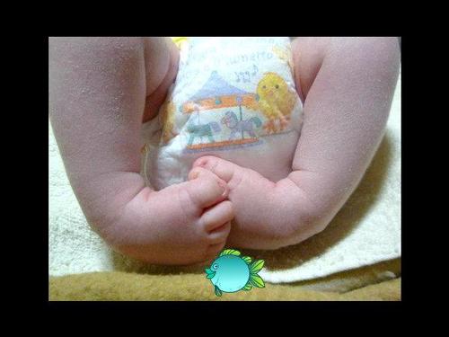 piedetorto's profile picture. piede torto  piede equino varo supinato clubfoot talipes pie zambo pé torto