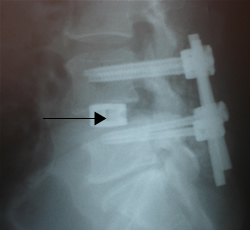 Back pain specialist Cox technic certified for disc cases with special interest in continued post-surgical back pain cases.