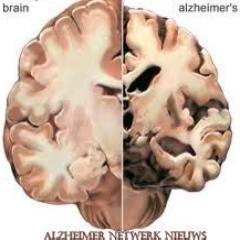 Actueel nieuws over de ziekte van Alzheimer.