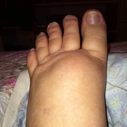 SurferSuzieB's profile picture. Living with lymphedema ...