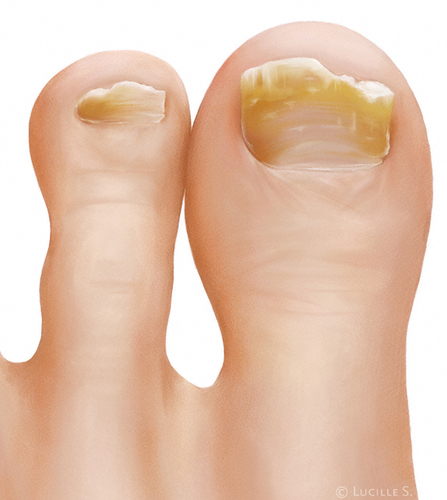 Über 12 Prozent der Bevölkerung in Deutschland leiden eine Krankheit namens Nagelpilz! Holen Sie sich ein Paar gesunde Füße!