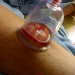 infohijama's profile picture. What is Hijama/Cupping Therapy ?

Cupping is one of the oldest and most effective methods of releasing toxins from the body tissues and organs.