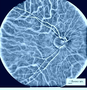 helping eye doctors see the last frontier in the eye....rpe and choroid