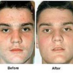 AcneProductsx's profile picture. Collection of various Acne Products. Find your favorite Acne Products here.