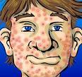 Trying to find a cure for Acne one step at a time.